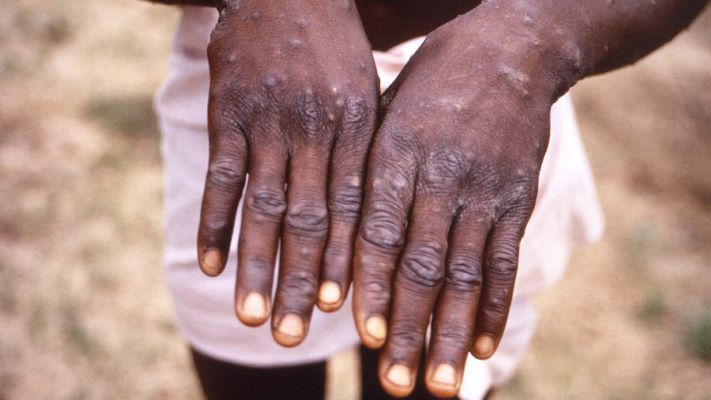 Científicos africanos desconcertados por como se propagó la viruela símica