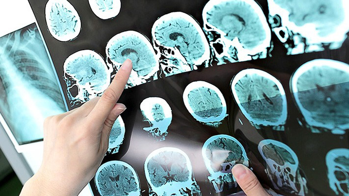 Buscan usar IA para detectar Alzheimer en forma temprana