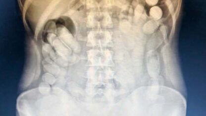 capsulas, capsulero, cocaína, droga, radiografía, Tucumán