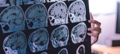 Afirman que se podría prevenir un 45% el riesgo de demencia